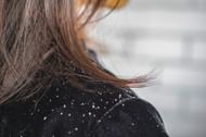 Myths and facts about dandruff (Image via iStockPhoto)